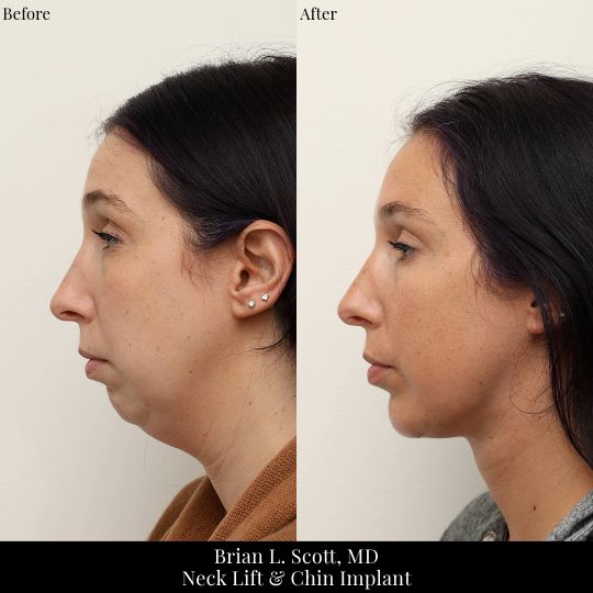 Neck-Lift-Chin-Implant-Seattle