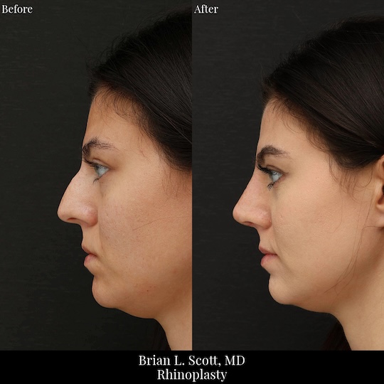 Hump Rhinoplasty Italian Nose