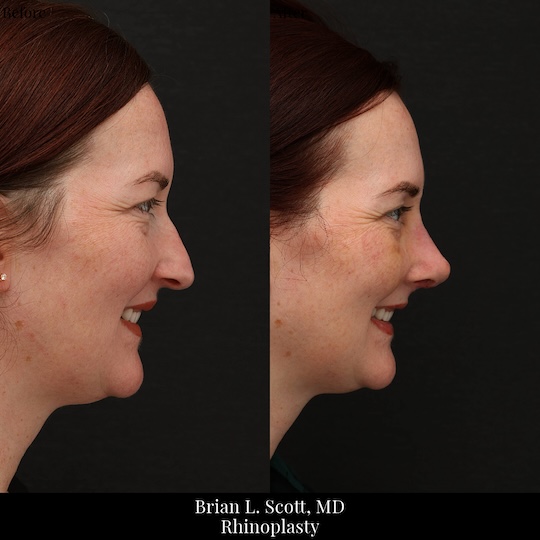 Kirkland Rhinoplasty