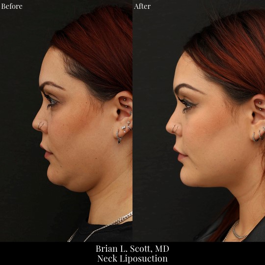 Neck and Chin Liposuction Seattle