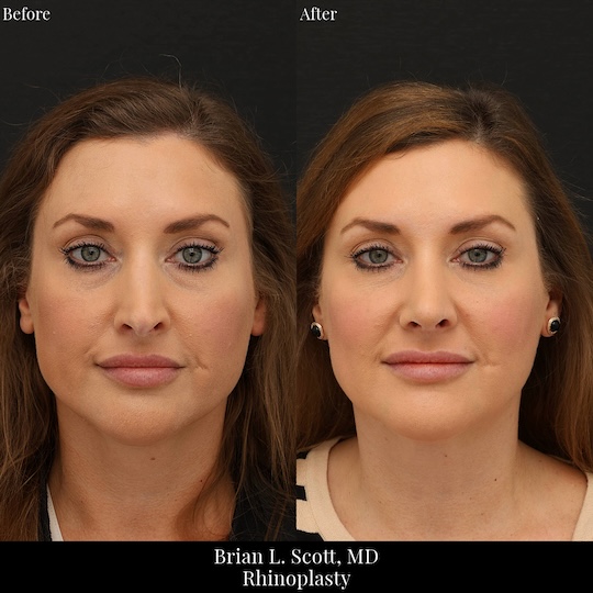 Bifid Split Tip Rhinoplasty