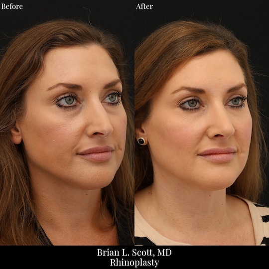 Bifid Split Tip Rhinoplasty