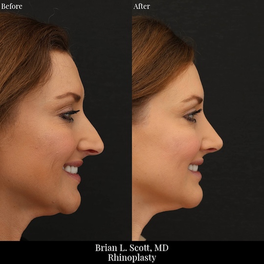 Bellevue Rhinoplasty