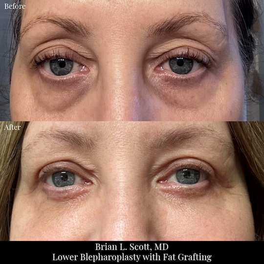 Lower eyebag removal and fat grafting