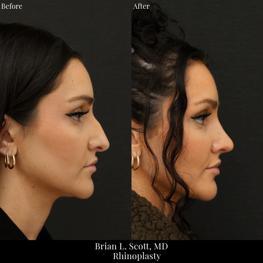 Rhinoplasty for Hump Bellevue