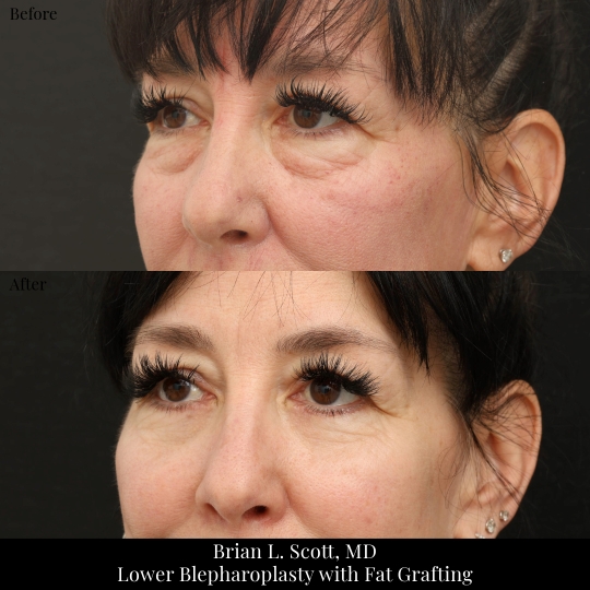 Lower Blepharoplasty with Fat Grafting