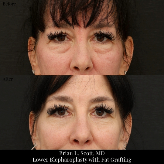 Lower Blepharoplasty with Fat Grafting