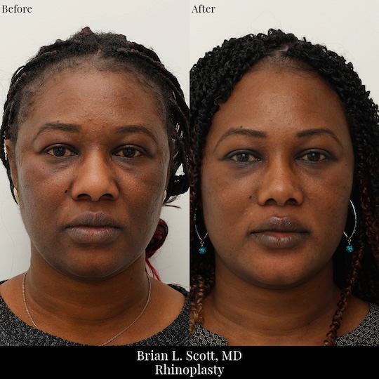 Ethnic Rhinoplasty Specialist