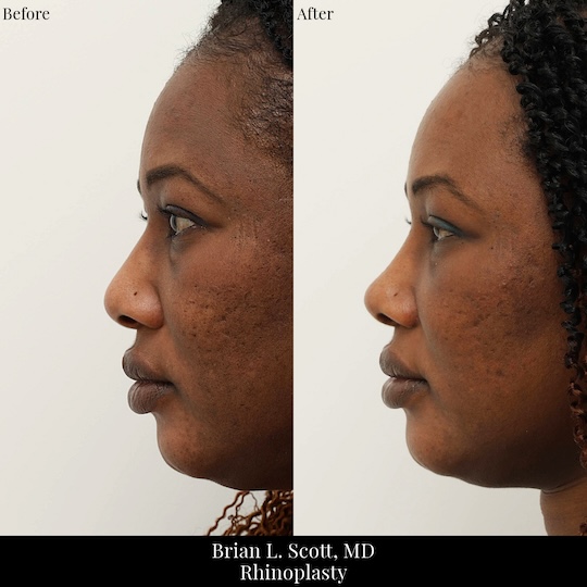Ethnic Rhinoplasty Seattle