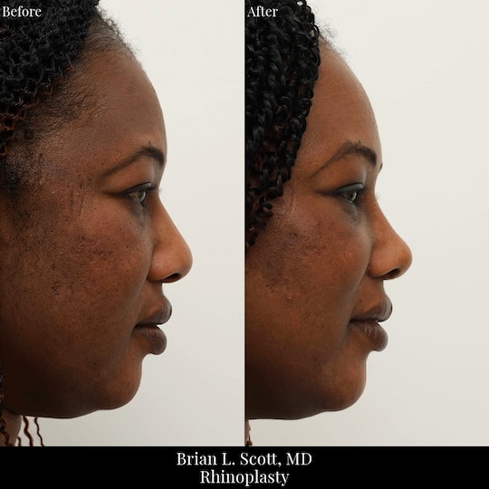 Black Rhinoplasty Seattle