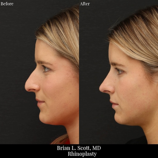 Natural Looking Rhinoplasty in Bellevue