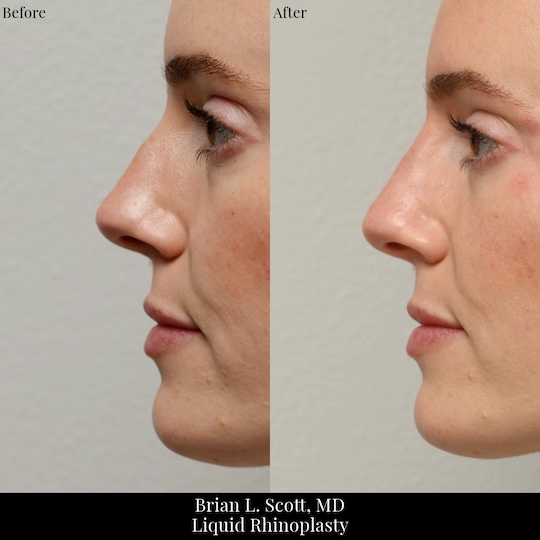 Liquid Rhinoplasty (Filler Rhinoplasty)