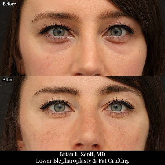Lower blepharoplasty with fat grafting