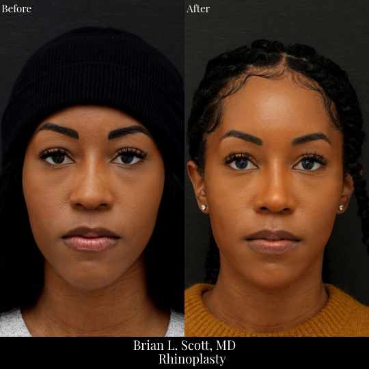 Ethnic Rhinoplasty Seattle