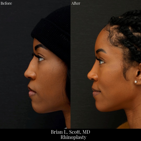 Black Rhinoplasty Seattle