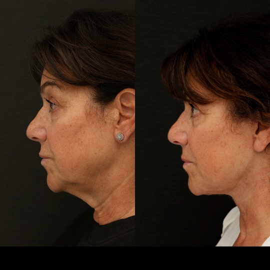 Deep Plane Facelift and Lower Blepharoplasty Bellevue