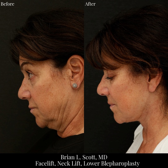 Deep Plane Facelift and Lower Blepharoplasty Bellevue