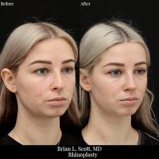 Nosejob B&A Belleuve