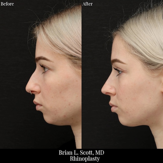 Nosejob B&A Belleuve