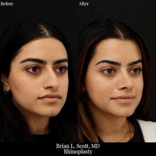 Middle Eastern Rhinoplasty