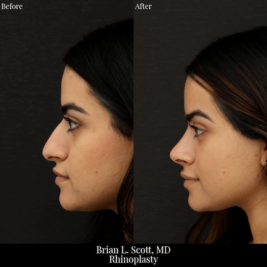 Middle Eastern Rhinoplasty