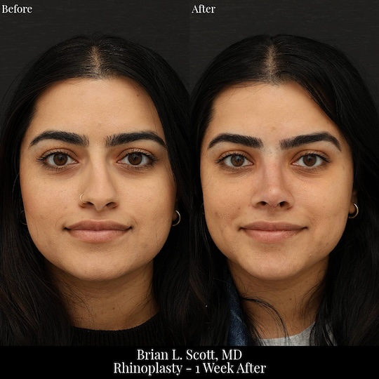 Bruising After Rhinoplasty