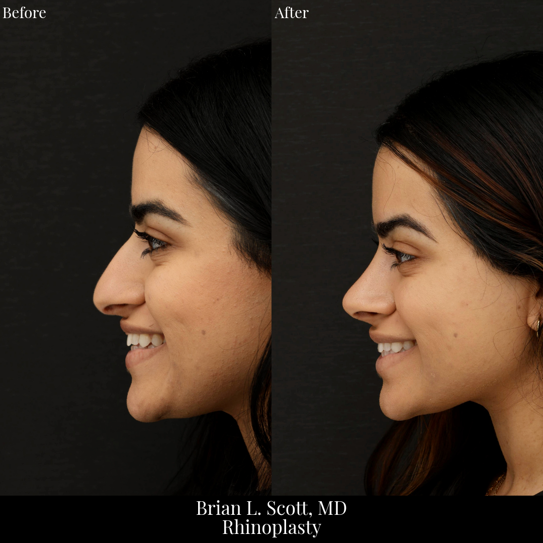 Middle Eastern Rhinoplasty