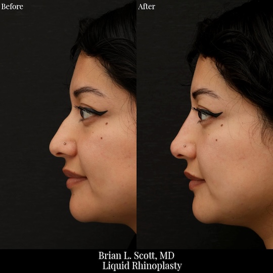 Liquid Rhinoplasty (Filler)