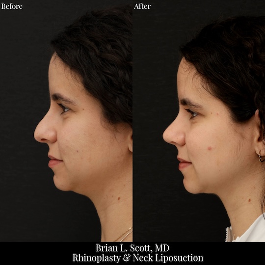 Rhinoplasty and Neck Liposuction Seattle