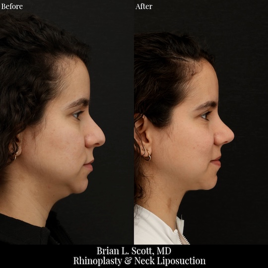 Rhinoplasty and Neck Liposuction