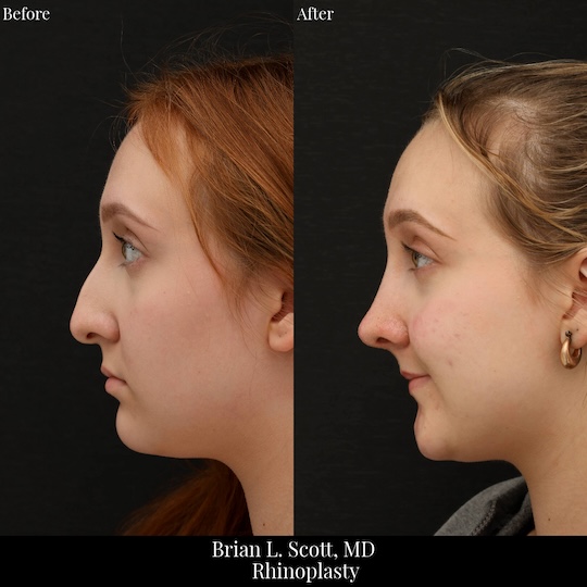 Top Rhinoplasty Doctor Seattle