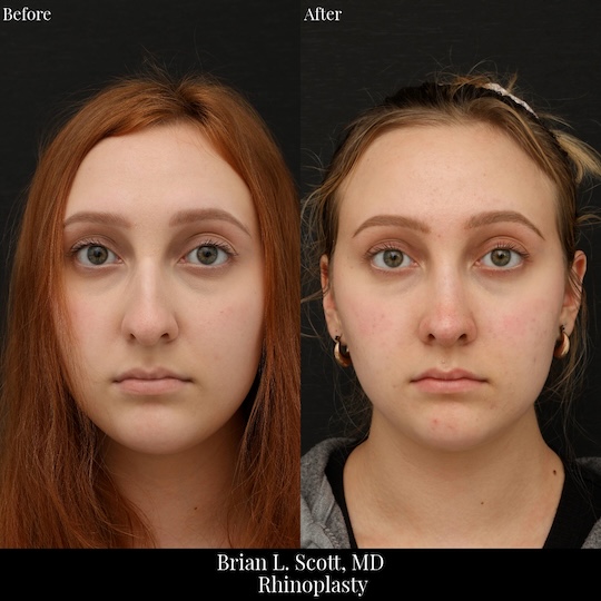 Top Rhinoplasty Doctor Seattle
