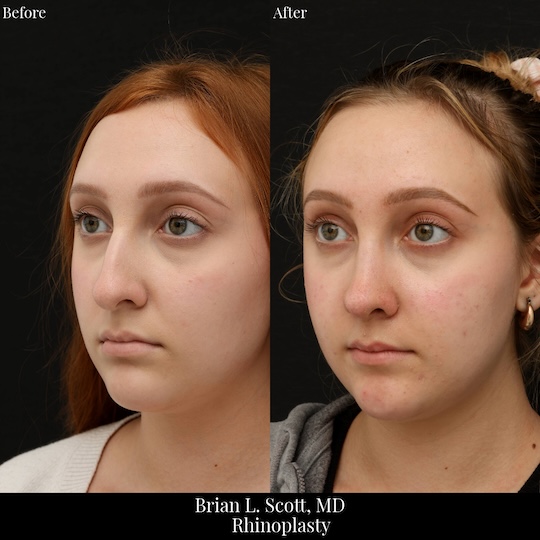 Top Rhinoplasty Doctor Seattle