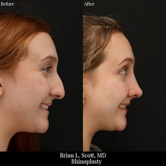 Top Rhinoplasty Doctor Seattle