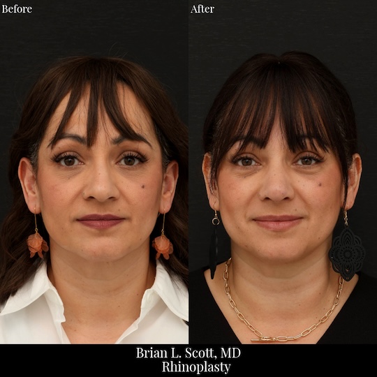 Best Rhinoplasty Washington