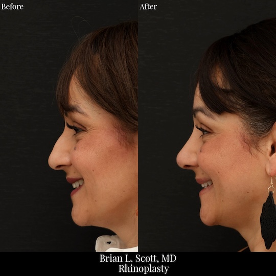 Natural Rhinoplasty Results