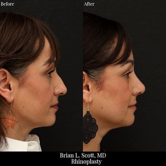 Rhinoplasty Hump