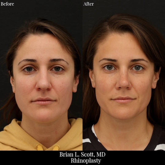 Best Rhinoplasty Seattle