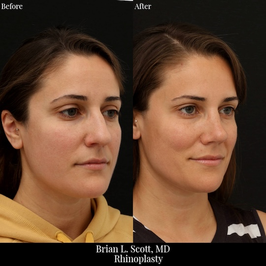 Best Rhinoplasty Bellevue