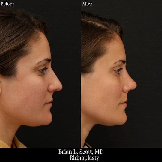 Best Rhinoplasty Seattle