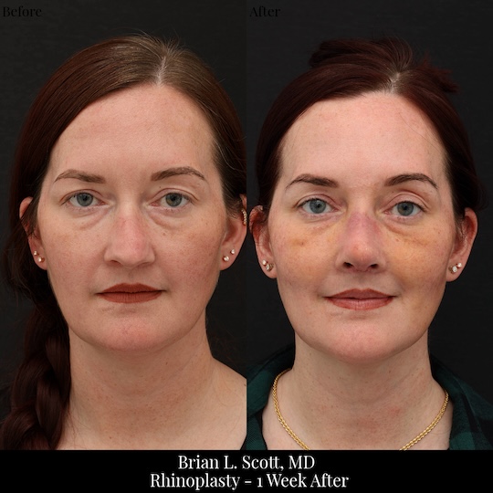 Bruising After Rhinoplasty