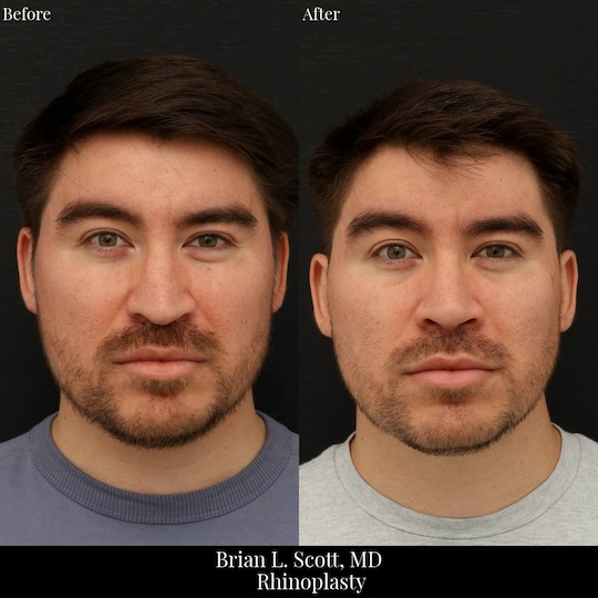 Male Rhinoplasty Seattle