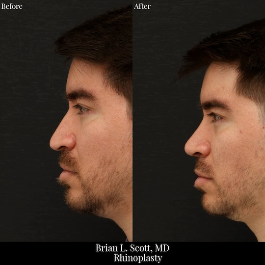 Male Rhinoplasty Seattle