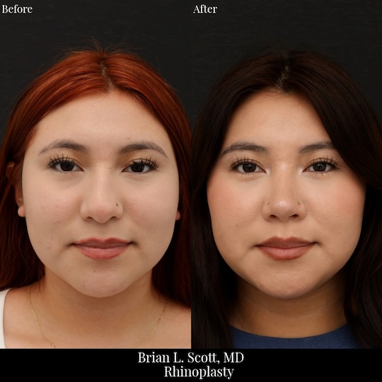 Best Rhinoplasty Seattle