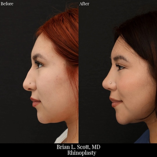 Hispanic Rhinoplasty Seattle