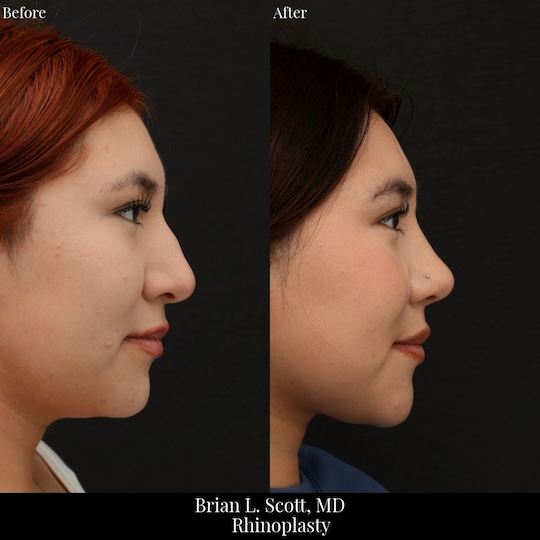 Hispanic Rhinoplasty Seattle