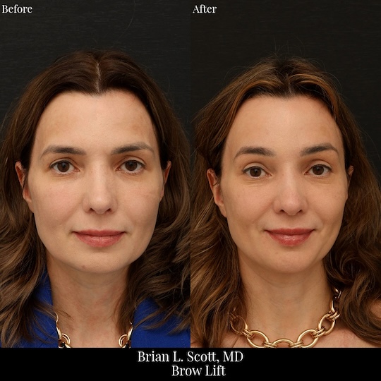 Best Brow Lift Seattle