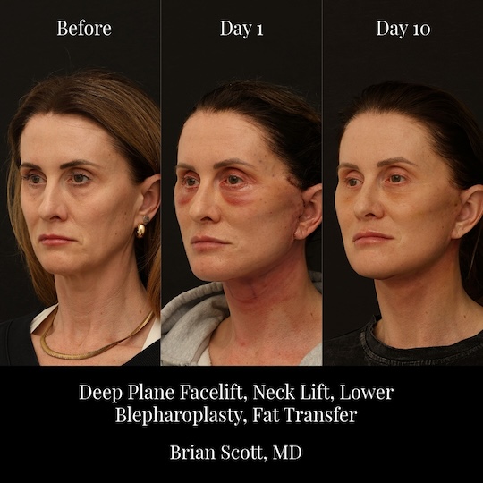 Facelift Healing